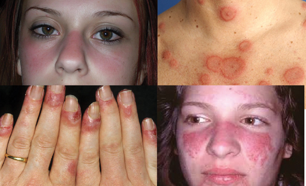 Lupus ban đỏ hệ thống có thể xuất hiện ở nhiều vị trí.jpg